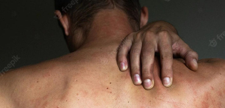 psoriasis-masculina-hombre-piel-síntomas-causas