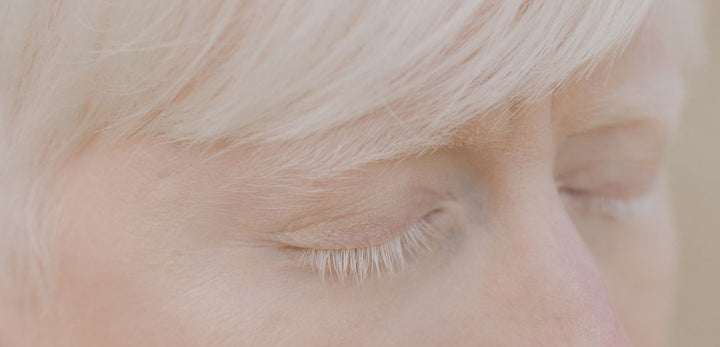 albinismo-personaalabina-albino-hombre-piel-ojos-melanina